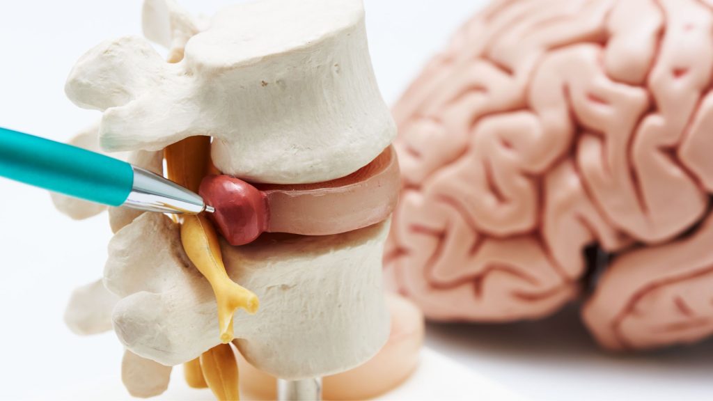 Lumbar Spine Disc Herniation – What is this?
