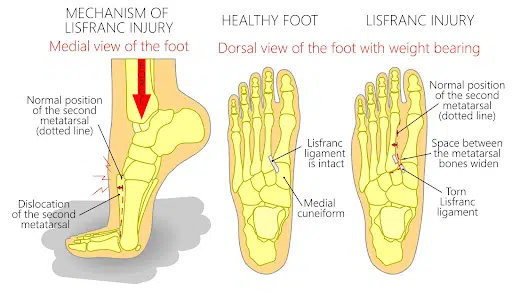 Lisfranc Injury & Physio Rehabilitation